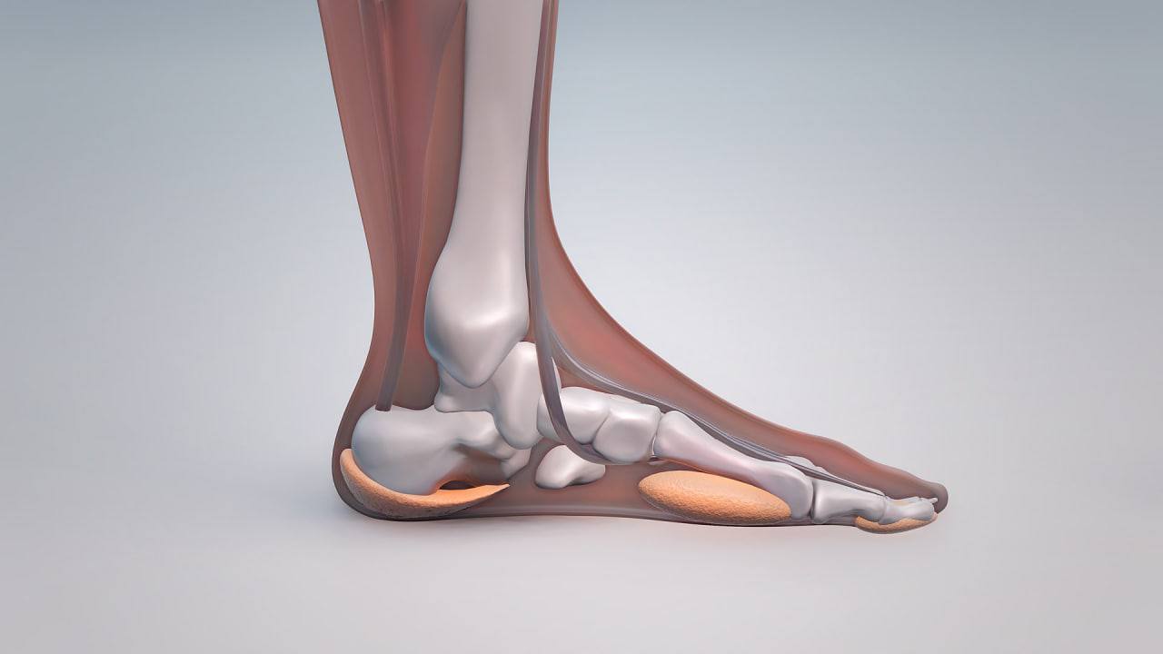 Изготовление протезов ног — «Медитроника Футсистемс»